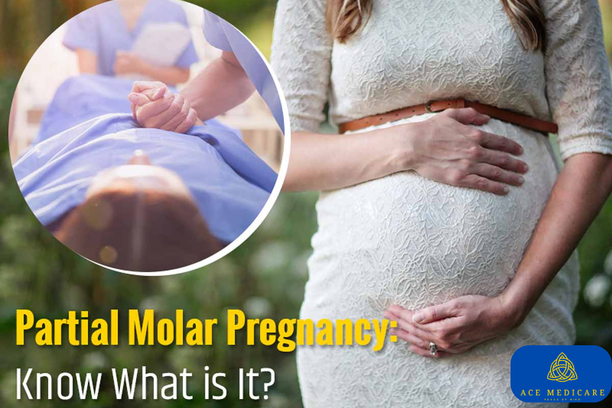 Molar Pregnancy: What Every Woman Should Know